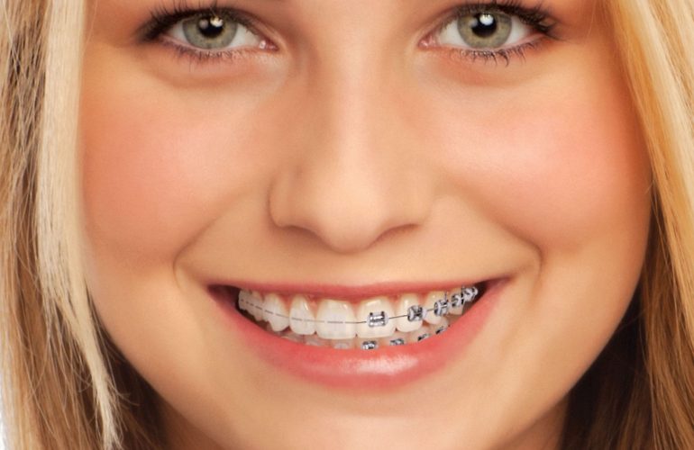 imagen de brackets-cerámica-ortodoncia-clinica-dental-san sebastian