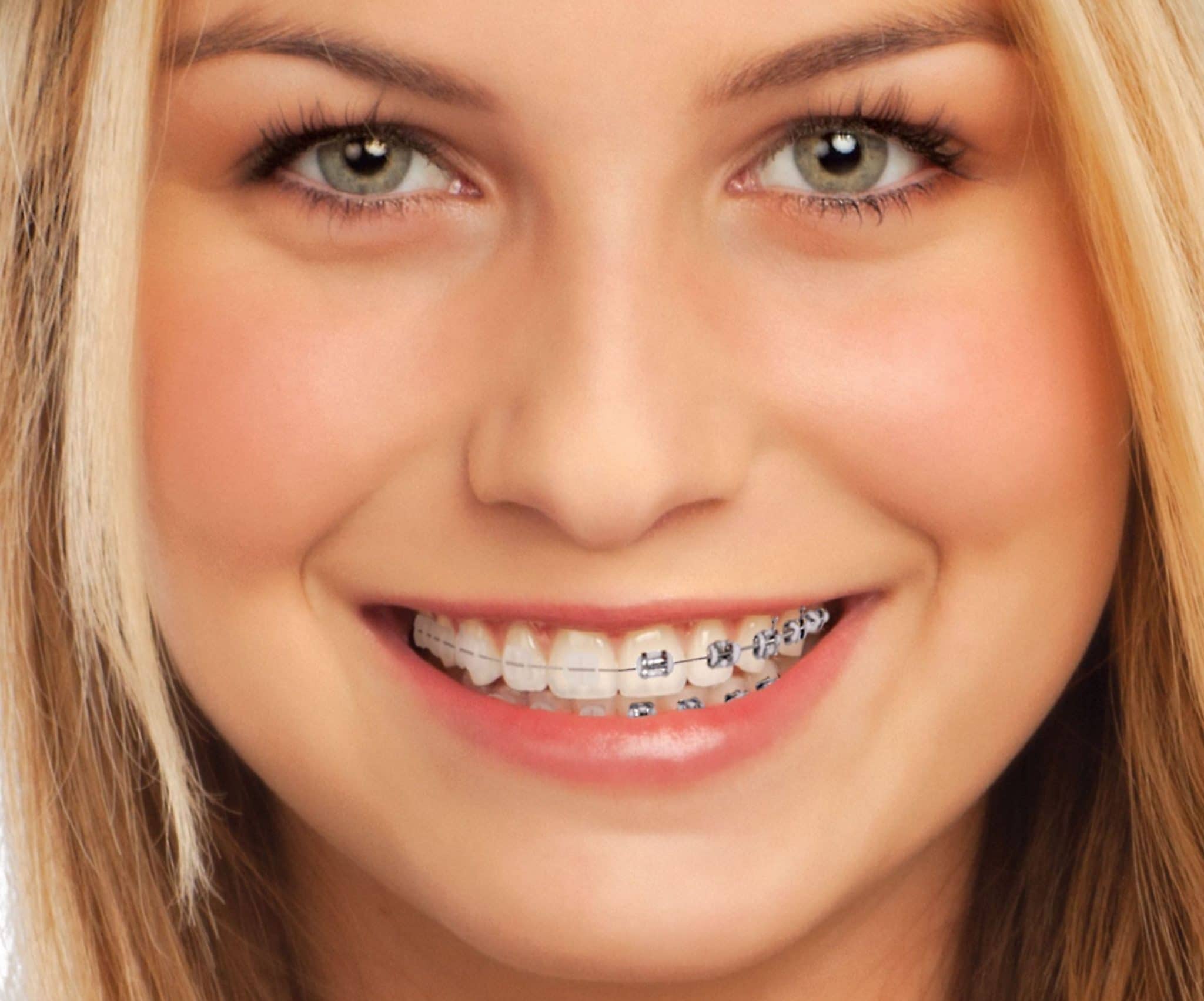 imagen de brackets-cerámica-ortodoncia-clinica-dental-san sebastian