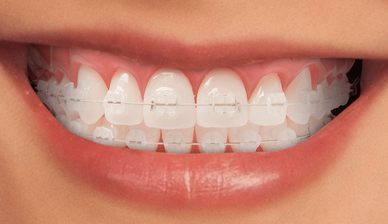 imagen de ortodoncia estetica brackets clinica dental san sebastian